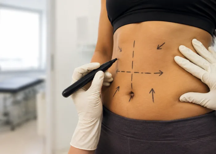 Surgical Body Contouring Options