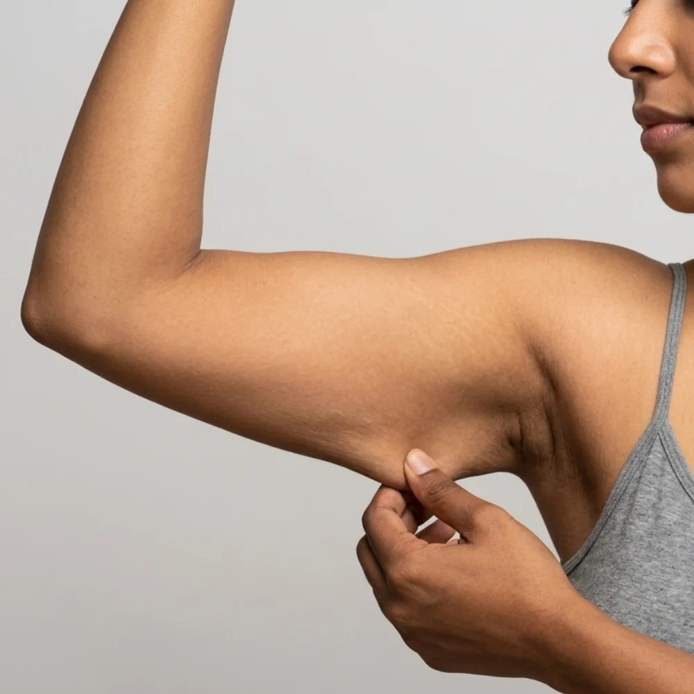 Why Does Loose Skin Develop After Weight Loss?