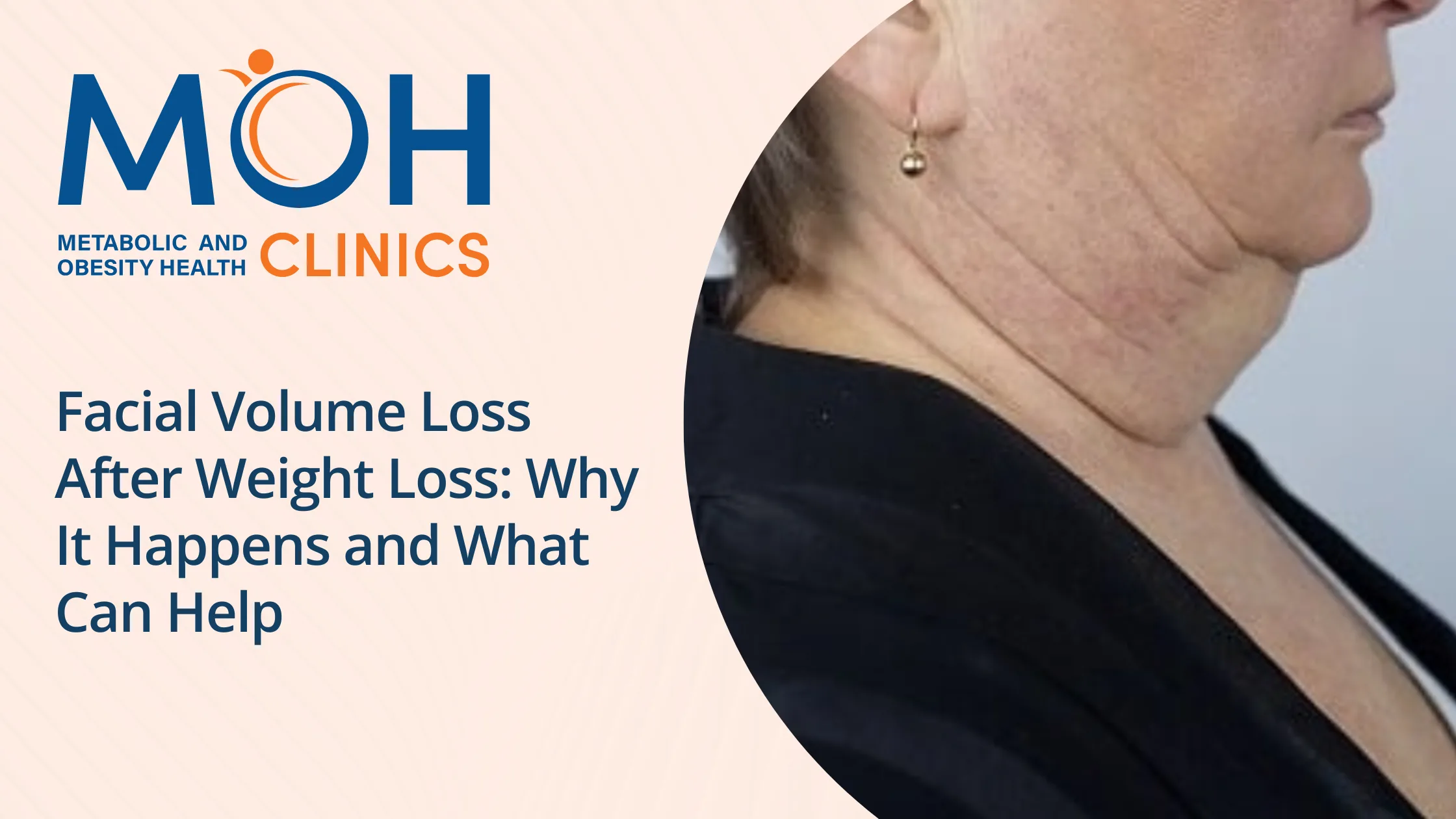 Facial Volume Loss After Weight Loss: Causes & Solutions